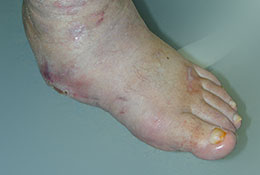 Der diabetisch-neuropathische Fuß: orthopädietechnische Versorgung